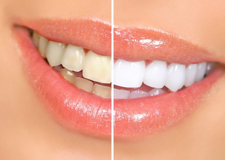 Things to Look for When Searching for a Cosmetic Dentist